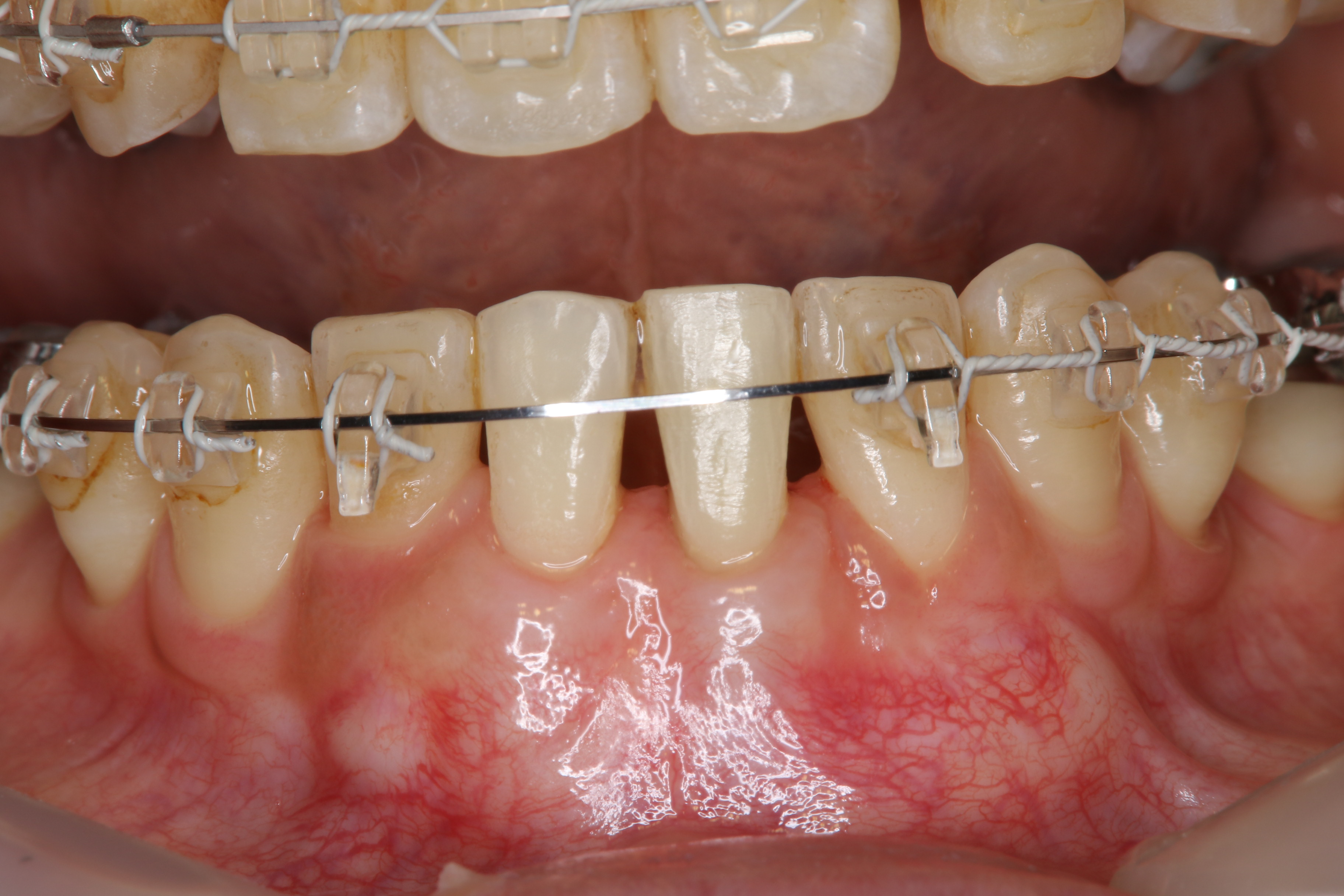 他院にて矯正治療中に歯ぐきが下がってきた